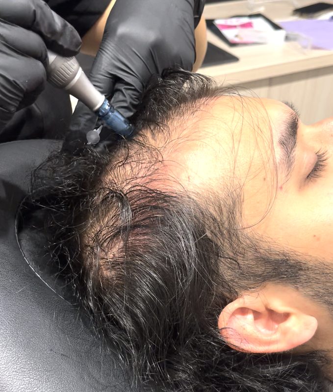 Microneedling + Exosomes (Hair)